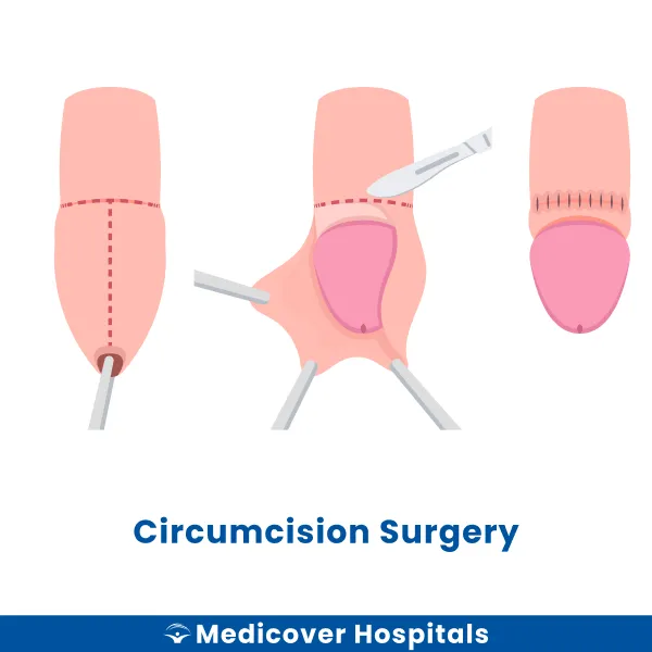 Circumcision Surgery