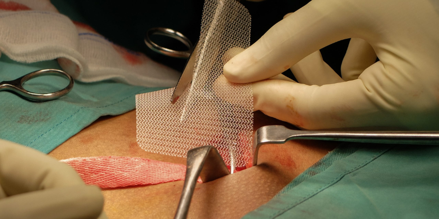 Hernia Surgery in Chennai