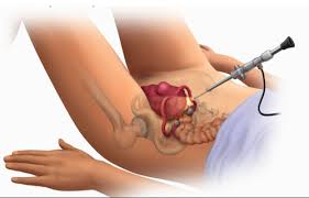 Uterus Removal