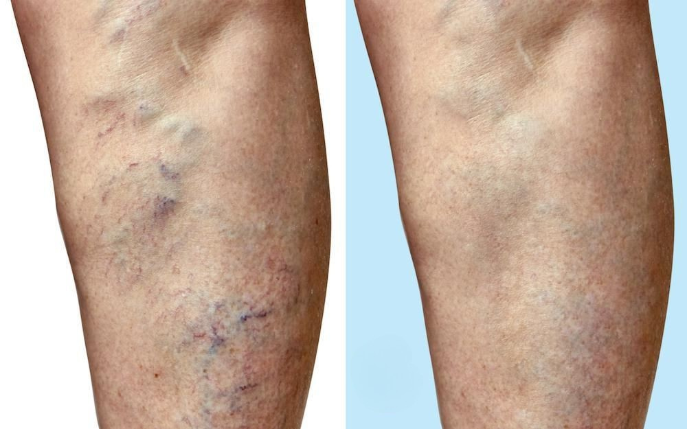 Varicose Veins Treatment